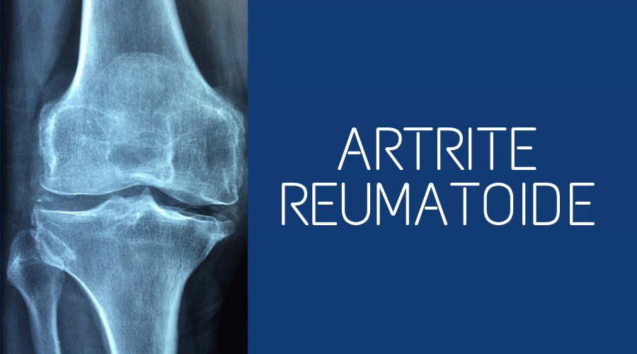 primi sintomi di artrite reumatoide